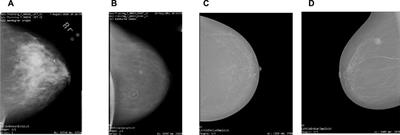 Breast cancer detection: Shallow convolutional neural network against deep convolutional neural networks based approach